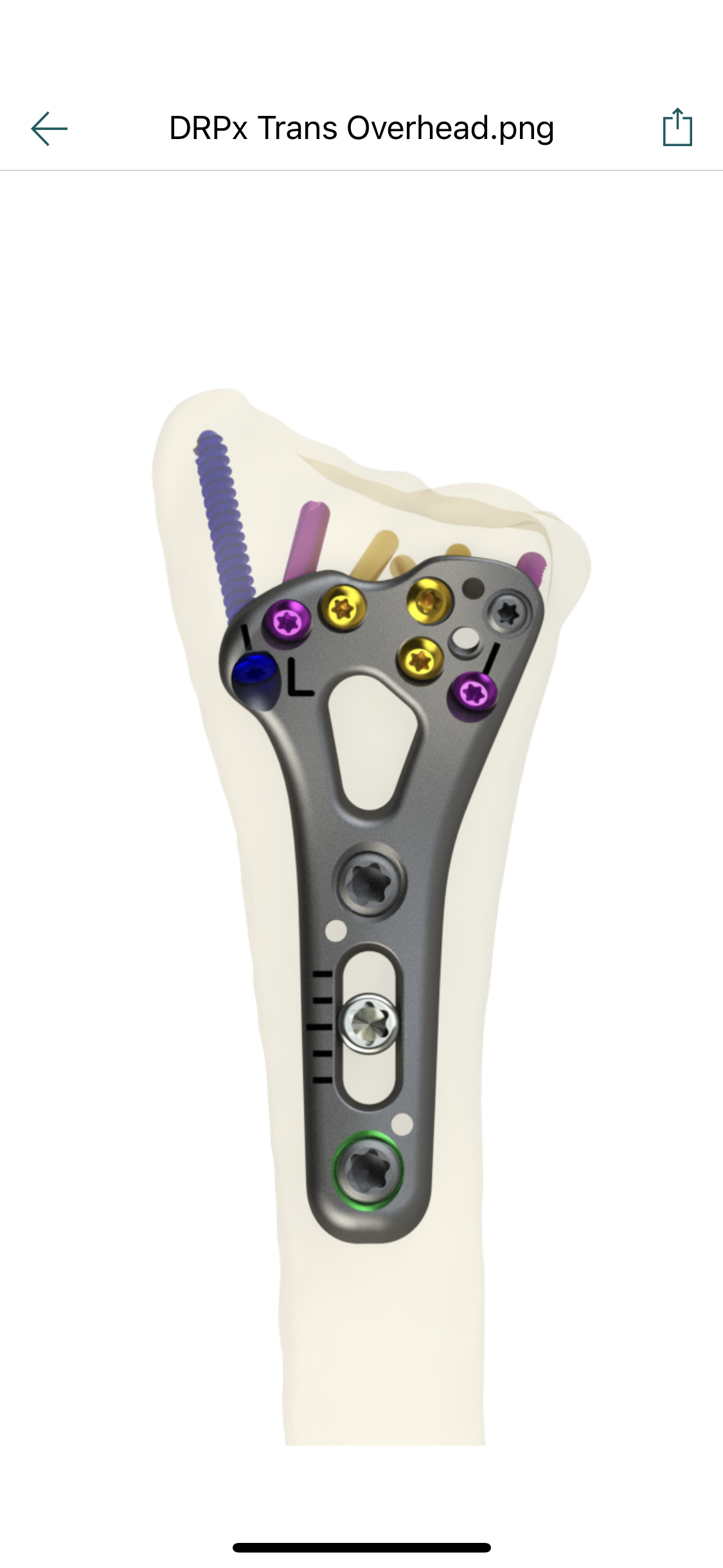 DRPx Distal Radius Plating System — image 1